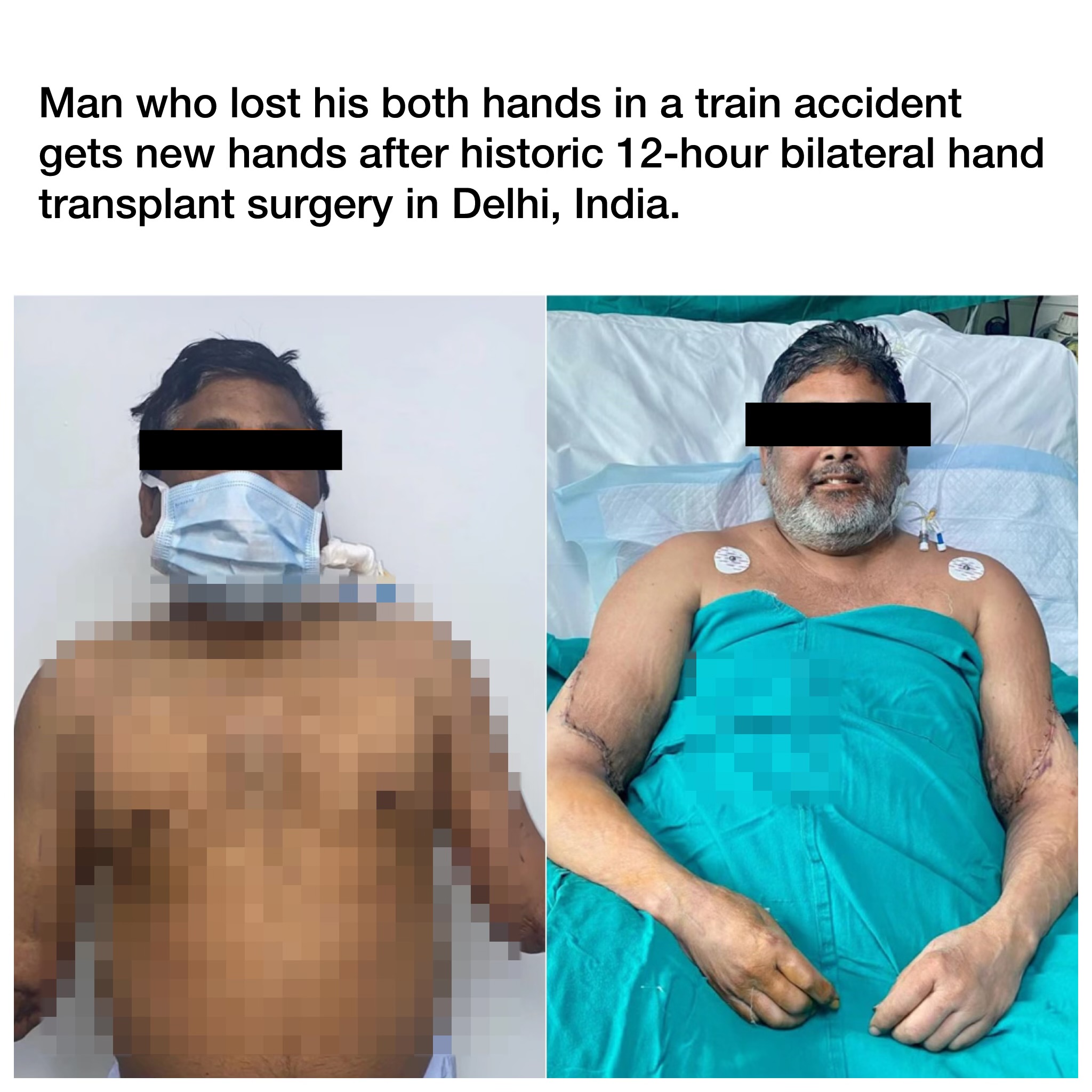 Miracle in Delhi: Man Receives New Hands in Landmark 12-Hour Bilateral Hand Transplant Surgery
